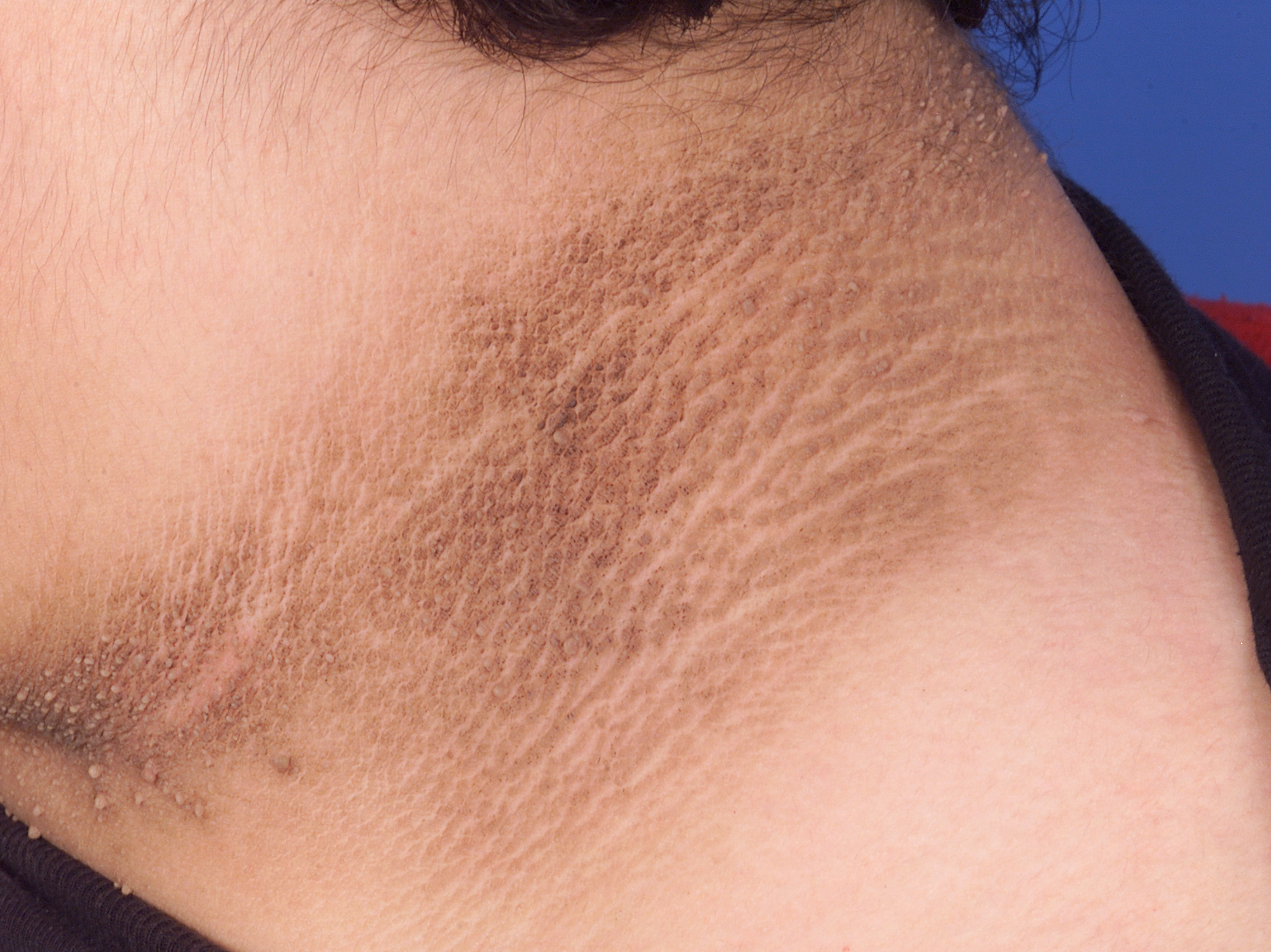 Acanthosis nigricans - Wikipedia