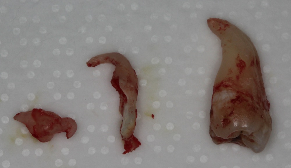 Tooth Extraction Food Getting In Socket Tooth Extraction Food Getting In Socket