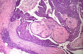 mesothelioma awareness t-shirts