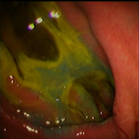 throwing up yellow liquid bile reflux china pdf ppt reports symptoms treatment throwing up yellow liquid bile reflux china pdf ppt reports symptoms treatment