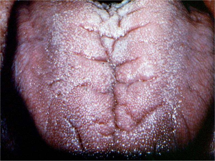 hairy tongue disease #10