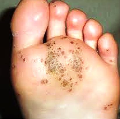 level three cervical cancer