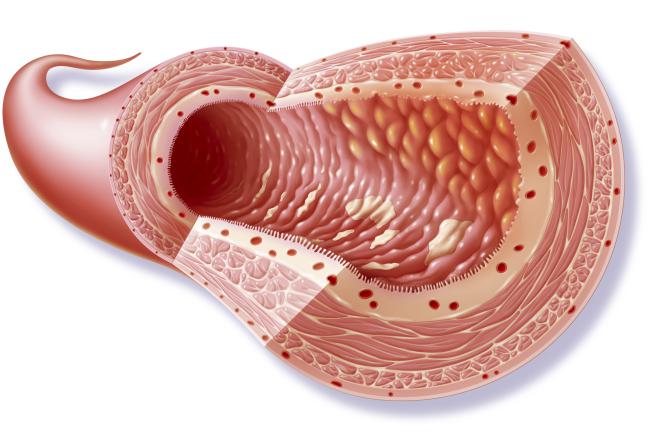 Sex and crohn s disease