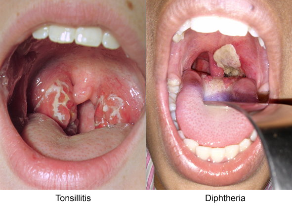 Oral Thrush – Symptoms, Pictures, Causes, Treatment ...