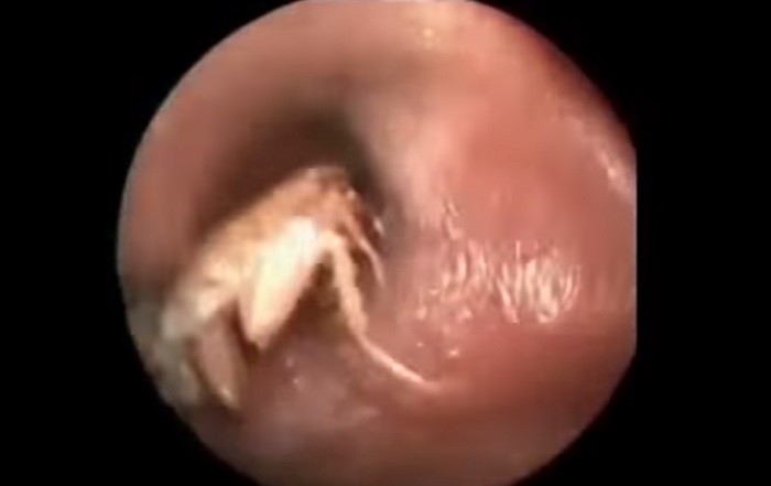 Compacted Ear Wax 55