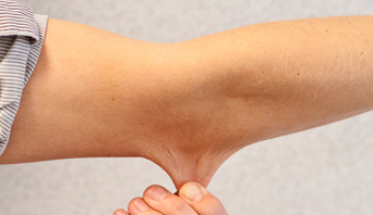 Hypermobility syndrome in adults