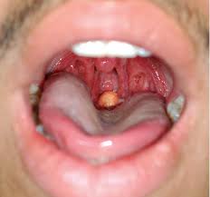 epiglottitis epiglottis children symptoms child type treatment disease inflammation affects haemophilus influenzae tongue