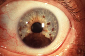 Eye melanoma Russia PDF PPT Case Reports Symptoms Treatment