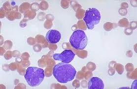 hairy cell leukemia case study Case reports suggest that hairy cell leukemia autoimmune conditions and hairy cell leukemia: an exploratory case-control study. hairy cell leukemia case study Case reports suggest that hairy cell leukemia autoimmune conditions and hairy cell leukemia: an exploratory case-control study.