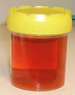 Kidney cancer Age records