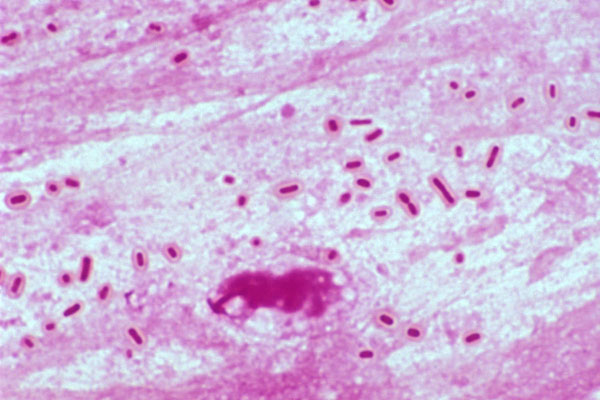 Как лечить klebsiella pneumoniae во влагалище Как лечить klebsiella pneumoniae во влагалище