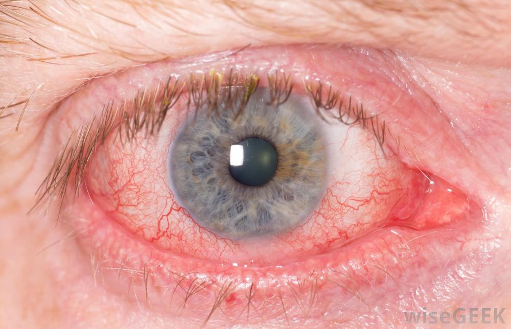 Horner Syndrome Canada Pdf Ppt Case Reports Symptoms Treatment Horner Syndrome