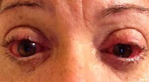 Peer Reviewed Articles Rheumatoid Arthritis