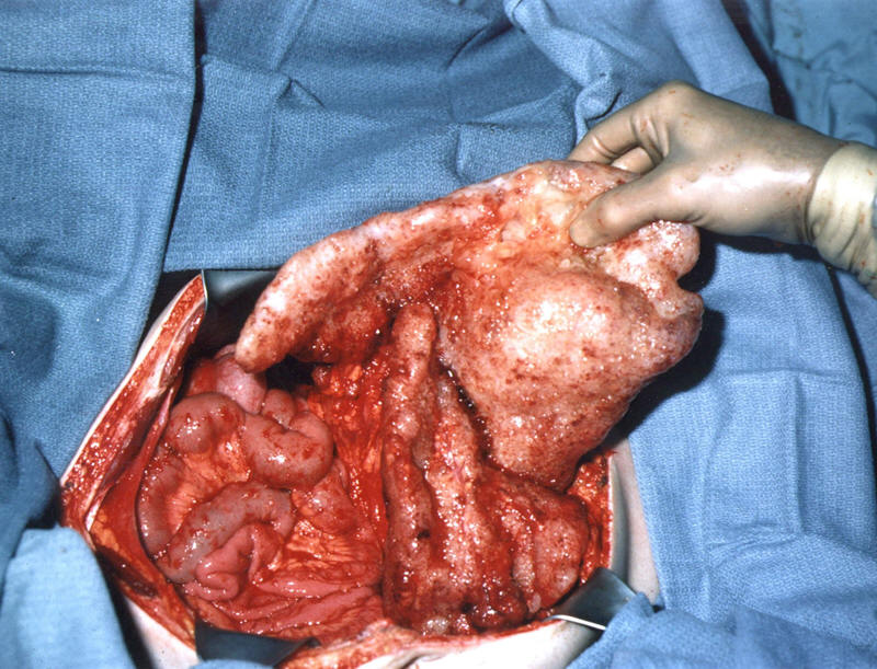 most cancers du sang premiers symptomes