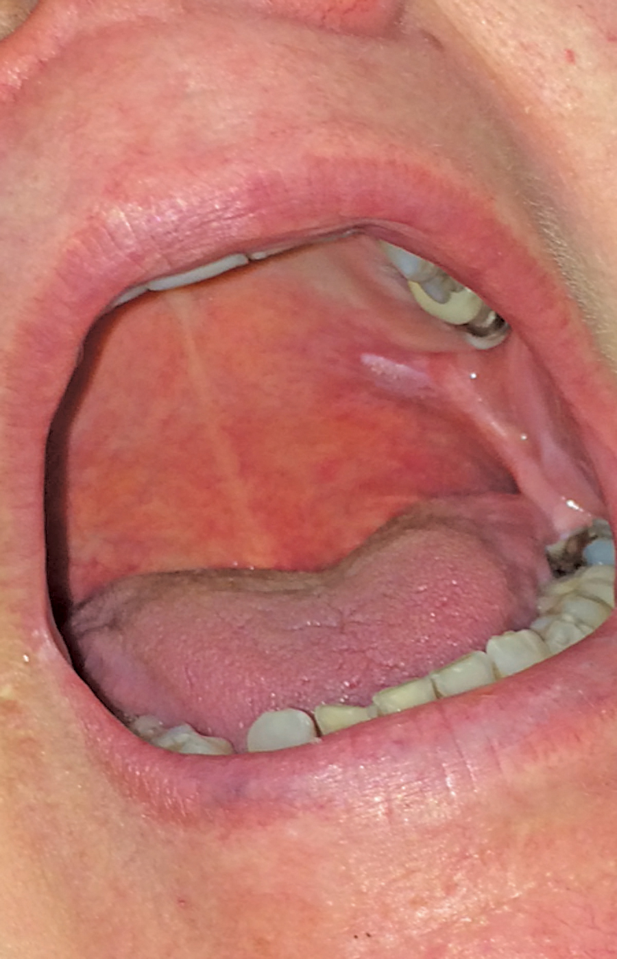 Soft Palate Mouth 102