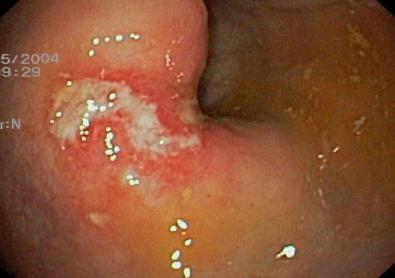 Wife spunk 2007 jelsoft enterprises ltd Symptoms of anal ulcers
