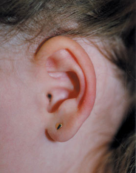 Steroid ear drops for otitis externa