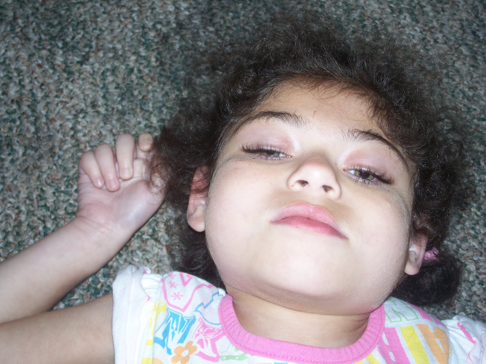 Absence seizure Unitedstates PDF PPT Case Reports Symptoms