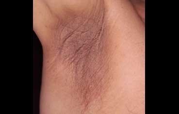 pseudo acantosis nigricans diabetes fotos