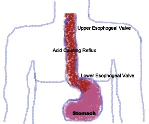 Acid Reflux | Sweden| PDF | PPT| Case Reports | Symptoms ...