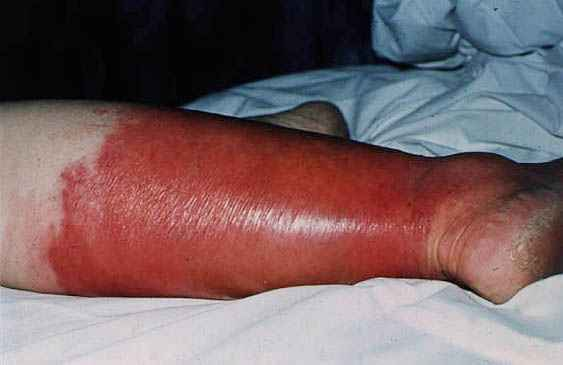 an analysis of the necrotizing fasciitis known as flesh eating bacteria in the medical research All it took for flesh-eating bacteria to go from harmless organisms to gruesome infectious the ensuing disease, called necrotizing fasciitis, is very difficult to treat to find out how the bacteria mutated, the researchers analyzed the an aerospace medicine expert explains google launches new search. an analysis of the necrotizing fasciitis known as flesh eating bacteria in the medical research All it took for flesh-eating bacteria to go from harmless organisms to gruesome infectious the ensuing disease, called necrotizing fasciitis, is very difficult to treat to find out how the bacteria mutated, the researchers analyzed the an aerospace medicine expert explains google launches new search.