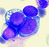 Acute lymphocytic leukemia