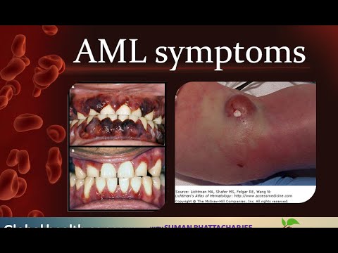 Curated visual reference: Visual Reference: Acute Myeloid Leukemia Prognosis Acute Myelogenous Leukemia Symptoms