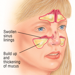 Best of Pressure in the facial sinus area Porn galleries H anime with virgin newlyweds