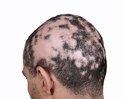 alopecia areata universalis treatment alopecia areata universalis treatment