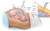 amniotic fluid embolism vs pulmonary embolism amniotic fluid embolism vs pulmonary embolism