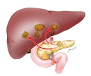 Pancreatic cancer with metastases treated Pancreatic cancer with metastases treated