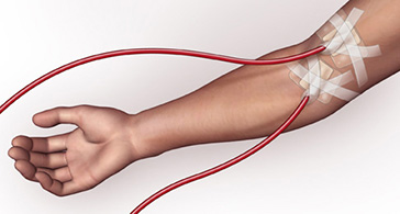 arteriovenous fistula india pdf ppt case reports symptoms