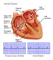 Atrial fibrillation
