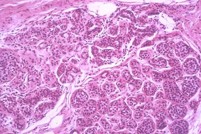 Breast atypical hyperplasia Breast atypical hyperplasia