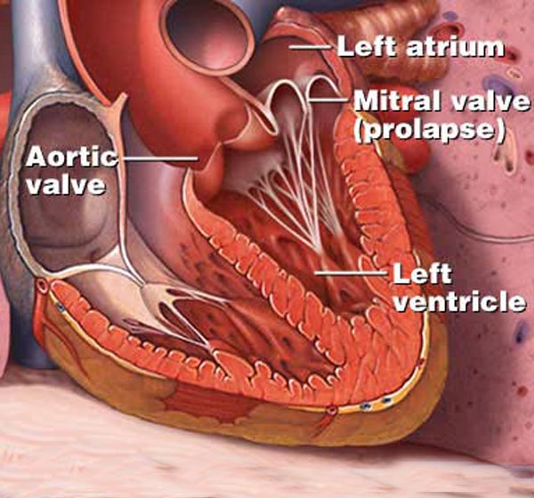 Строение сердца человека хорда. Сухожильные хорды сердца. Марс дополнительная хорда левого желудочка. Разрыв хорды митрального клапана. Что значит дополнительная хорда у ребенка.