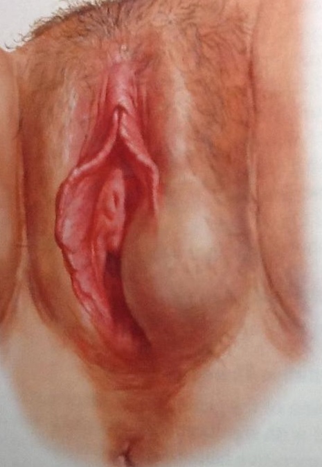 cyst or boil near vagina Cyst or boil near vagina