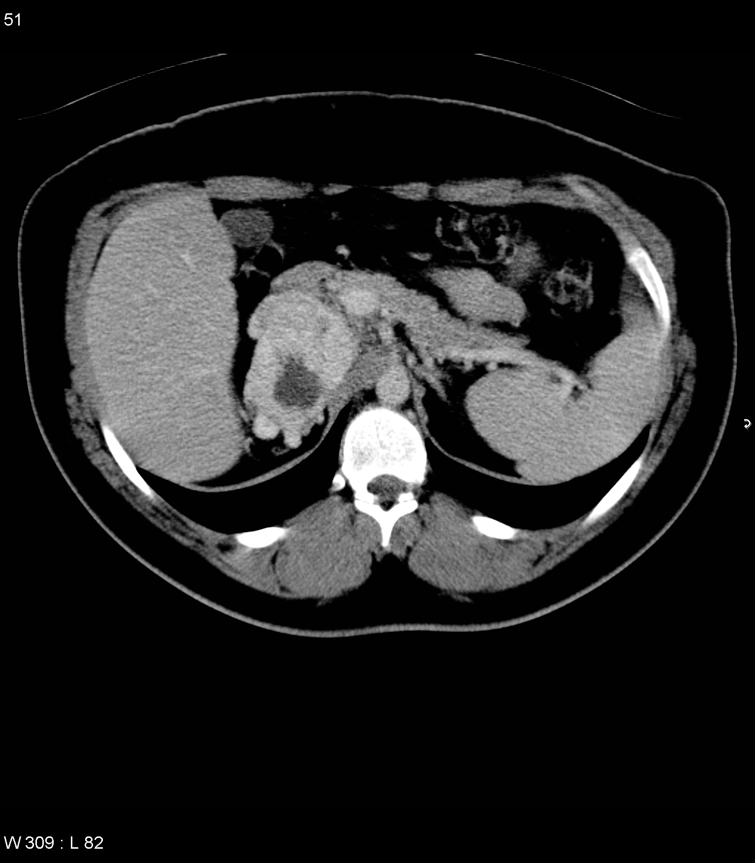 adrenal mass on kidney adrenal mass on kidney
