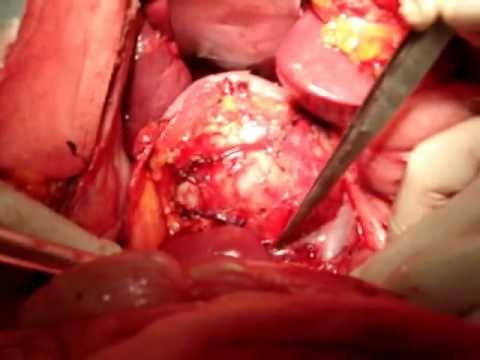 adrenal tumor on kidney adrenal tumor on kidney