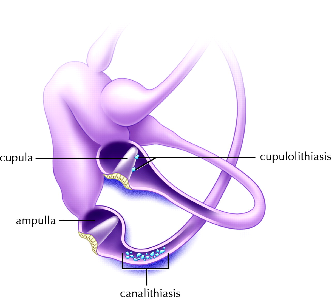 benign paroxysmal vertigo