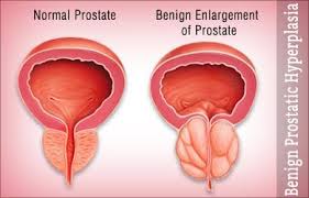 benign prostatic hyperplasia pathogenesis