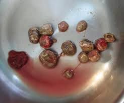 Bladder Stones | Dr Qaisar Ahmed MD, DHMS | PDF | PPT| Case Reports | Symptoms | Treatment