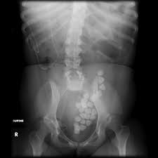 bladder stones symptoms bladder stones russia pdf ppt reports symptoms treatment bladder stones symptoms bladder stones russia pdf ppt reports symptoms treatment