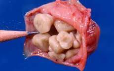 Bladder Stones Uk Pdf Ppt Case Reports Symptoms Treatment Bladder Stones Uk Pdf Ppt Case Reports Symptoms Treatment