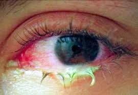 Adult clogged duct tear Adult clogged duct tear consider, that