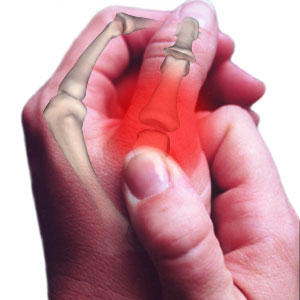 bone spurs canada pdf ppt case reports symptoms treatment