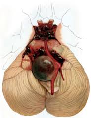 Brain aneurysm | India| PDF | PPT| Case Reports | Symptoms ...