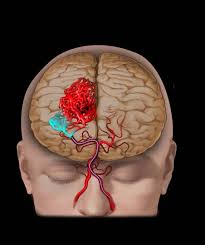 Brain AVM | Norway| PDF | PPT| Case Reports | Symptoms ...