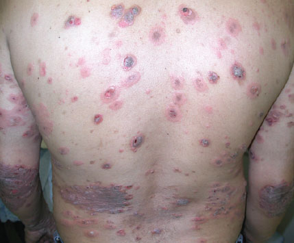 What is bullous pemphigoid?