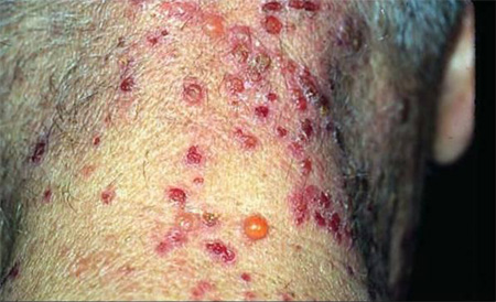 Bullous pemphigoid