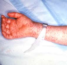 Burkholderia cepacia Infection
